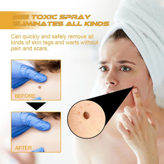 Instant Wart & Tag Removal Spray
